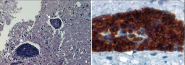 Fig 2. (A) Histopathological analysis: lymphoid clustering around the small cerebral vessels (arrows) H&amp;E 100x; (B) Immunohistochemical study: 