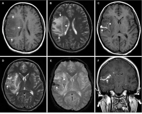 Fig 1. MRI showing thrombosed DVA  surrounded by frontoparietal  paren-chymal edema and tiny  intraparen-chymal hemorrhage in the right  insu-lar cortex