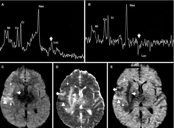 Fig 2. Single voxel  1 H-MRS, TE=35ms (A) and TE=144 ms (B) in the right frontoparietal region showed a pre- pre-served NAA peak and a positive doublet peak (A) and inverted doublet peak (B) at 1.31 ppm, indicating  lactate peak elevation