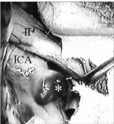 Fig 1. Left carotid angiogram. Note small aneurysm (arrow) on the  dorsal surface of ICA