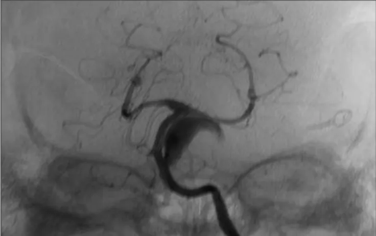 Fig 2. Vertebral angiogram conirms angiotomography indings. A gi- gi-ant partially thrombosed AICA aneurysm is evidenced