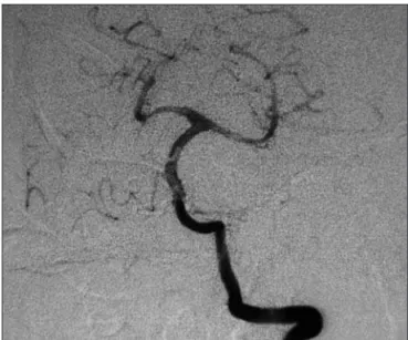 Fig 5. Postoperative angiogram depicts complete clipping of the an- an-eurysm without stenosis of the basilar artery.