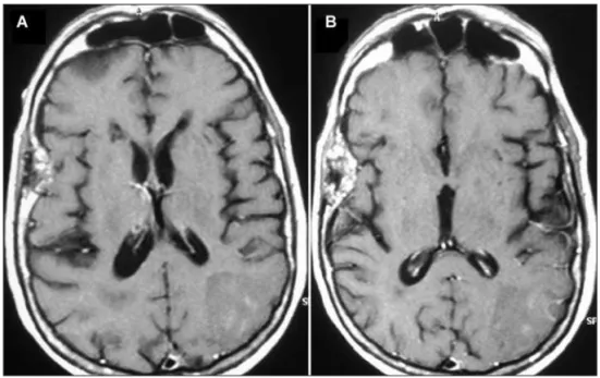 Fig 2. (A) Nonenhanced T1- weighted  MRI showing a right frontotemporal  osseous lesion and an ischemic area  on the left occipital region