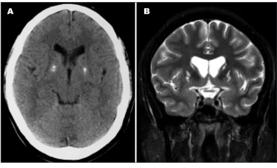 Fig 1. Neuroimaging results. (A) CT  demonstrates bilateral and  symmet-ric pallidal calciications