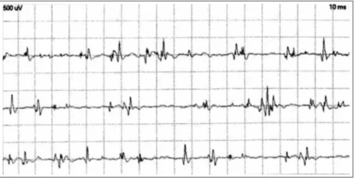 Fig 1. Small amplitude and short duration  (SASD) motor unit potentials and polyphasic  small amplitude motor unit potentials in  del-toid muscle.