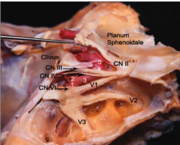 Fig 1. Cavernous sinus dissection, demonstrating cranial nerves: II- II-III-IV-V1-V2-V3-VI; 1, the posterior vertical segment; 2, the posterior  bend; 3, the horizontal segment; 4, the anterior bend; 5, the anterior  vertical segment (By Castro JAF, MD).