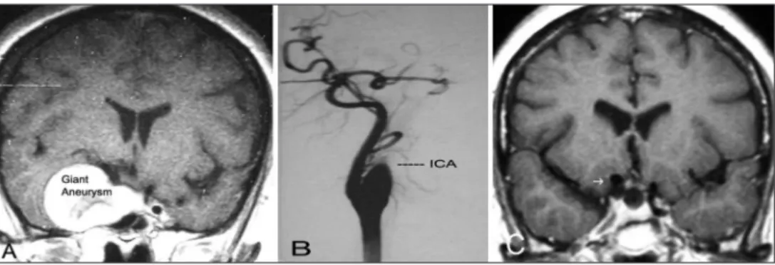 Fig 3. (A) MRI scan presenting a coronal slice in which can be seen giant aneurysm in right ICA in a 57  year old patient with headache and right III, IV and VI