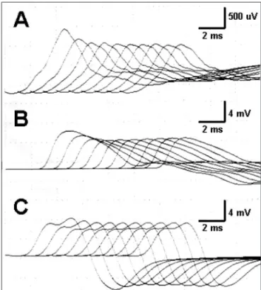 Fig 1. Repetitive stimulation at 3 Hz showing a 26.3% amplitude dec- dec-rement in compound muscle action potential in the facial nerve  re-corded from the orbicularis oculi muscle (A), a 24.4% decrement in  the spinal accessory nerve recorded from the tra