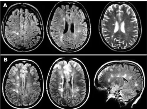 Fig 2. (A) First relapse (2003): multiple areas  of high signal on axial FLAIR and  T2-weight-ed images in the periventricular and  subcor-tical white matter of the brain hemispheres