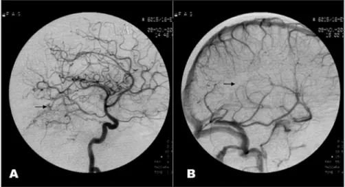 Fig 2. Cerebral angiography of the right inter- inter-nal carotid artery, lateral projection, on the  ar-terial fase (A) shows a dural AVF (arrow), and  on the venous fase (B) a poor profund venous  drainage (arrow), without visualization of the  internal 