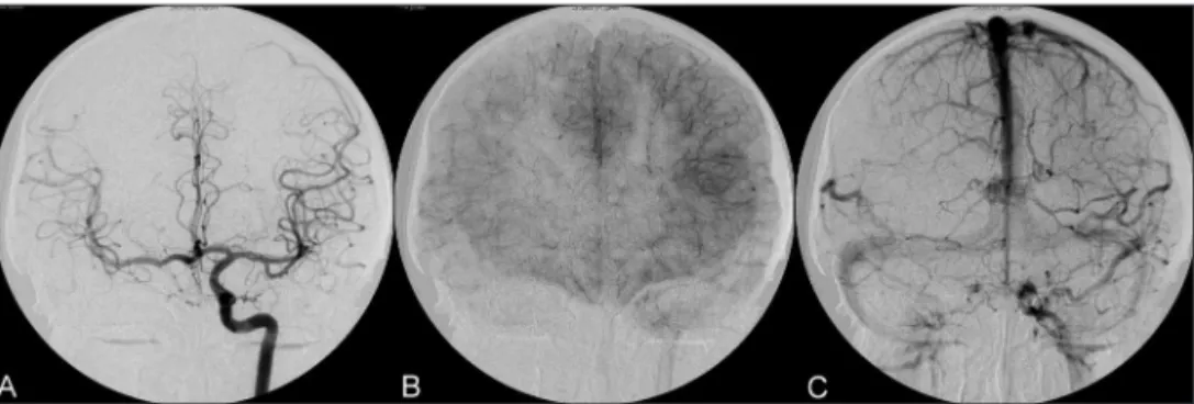 Fig 5. Case 2. Collateral circulation patency during six months follow-up, demonstrating aneurysm  exclusion and proper collateral circulation from contralateral ICA