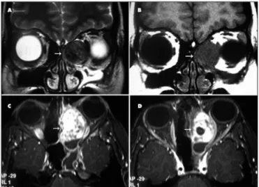 Fig 2. MRI: (A,B) axial image showing lesions hypointense in T2 and  T1-weighted sequences in the left ethmoid sinus