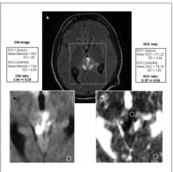 Fig 5. Percentual change of ADCs in necrotic area of lesion pre- and post-treatment with underlay of the correspond- correspond-ing FLAIR image: histogram analysis of this area yields a mean percentual increase of 67% and a maximum increase  of 142% in the