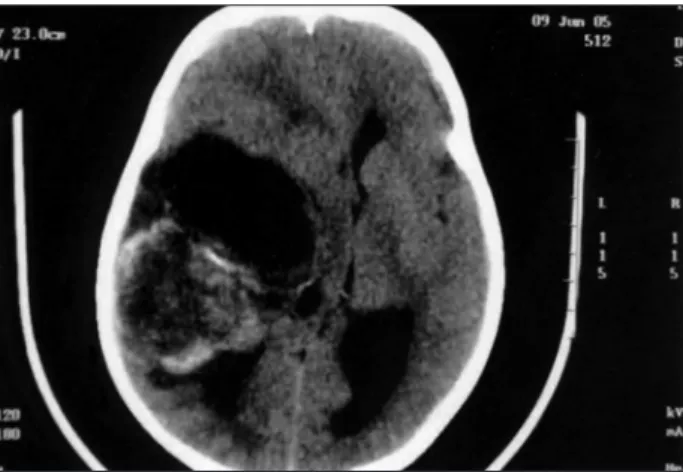 Fig 1. Computed tomography displaying a bulk tumor in right tem- tem-poral lobe, with peripheral enhancement after contrast medium  in-jection (axial view).