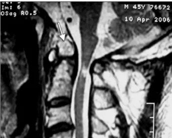 Fig 1. Sagittal T2 MRI of the cervical spine: anomalous bone element  at occipital-C1 transition, the dens is relatively short, the spinal cord  was narrowed at C1-2 level, with altered signal, compatible with  chronic edema or myelomalacia.