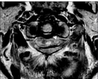 Fig 2. Axial MRI on T2 of C1-C2 level:, show a thick and laccid trans- trans-verse ligament, compatible with atlanto-axial chronic instability, the  spinal cord was narrowed at C1-2 level, with altered signal,  compati-ble with chronic edema or myelomalaci