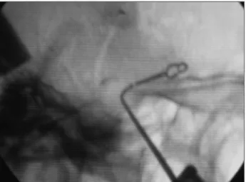 Fig 2. An intraoperative  plain ilm showing a lateral view of the sel- sel-lar region depicting the relationship between the previously clipped  ICA and the curette during the transsphenoidal removal of adenoma.