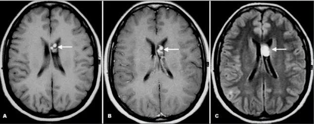 Fig 1. Axial T1-weighted pre- (A) and post-gadolinium (B) and FLAIR (C) MR images demonstrate multiple well-deined round  lesions in the frontal horn of the left lateral ventricle, with high signal on both sequences, and with no signiicant  enhance-ment af