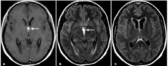Fig 2. Axial T1-weighted post-gadolinium (A) and FLAIR (B and C) MR images show a third ventricle multiloculated mass show- show-ing mild rshow-ing enhancement after contrast administration (arrow)