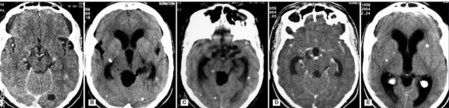 Fig 1. (A) Cranial CT showing lesions of cerebral cysticercosis; (B and C) Cranial CT showing cyst in the quadrigeminal cistern and dilatation of  the ventricular system; (D and E) Cranial CT showing the disappearing of the cyst in the quadrigeminal cister
