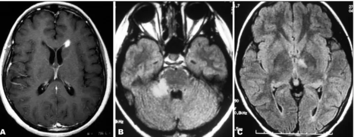 Fig 3. Abnormal brain MRI in patients with neuromyelitis optica. (A) Isolated gadolinium-enhancing periventricular lesion