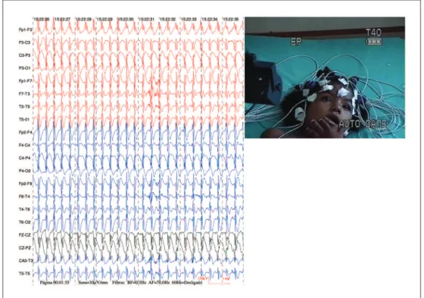 Fig 1. Registered ictal video-electroencephalographic showing complex of spike slow waves rhythmic of 3 Hz,  high amplitude, with projection widespread, synchronous and symmetrical, with duration of 18 seconds