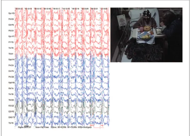 Fig 3. Registration ictal video-electroencephalographic evidence outbreak of poly spike wave complex, ap- ap-proximately 1.5 Hz, high amplitude, with widespread projection
