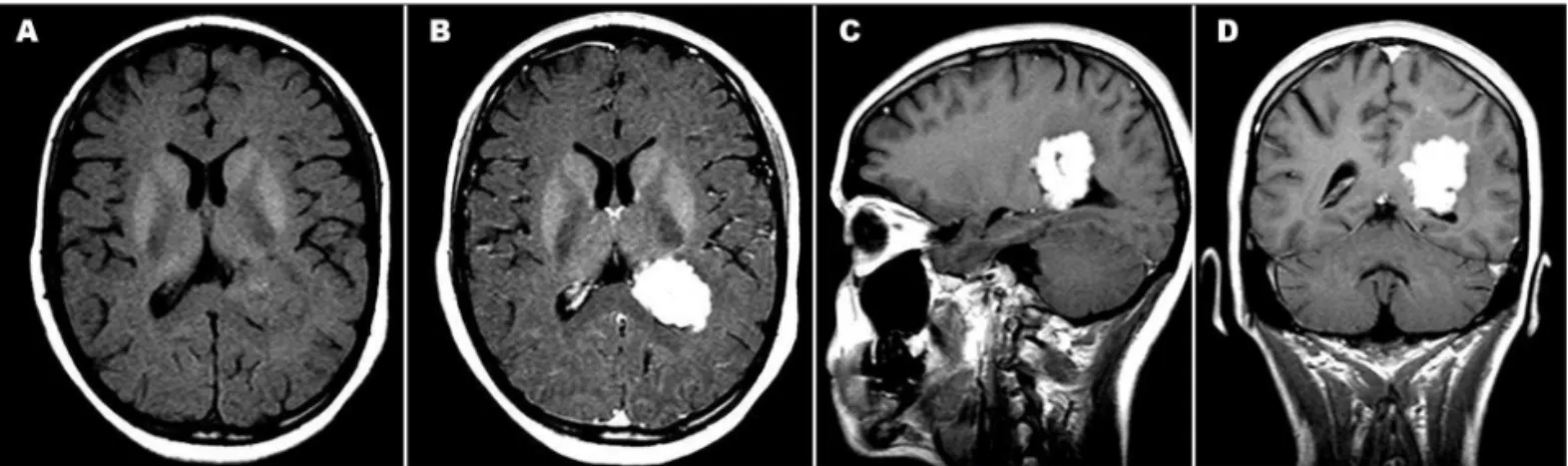 Fig 1. Brain T1-weighted MRI with a solitary 4 cm mass centred on the trigone of the left lateral ventricle