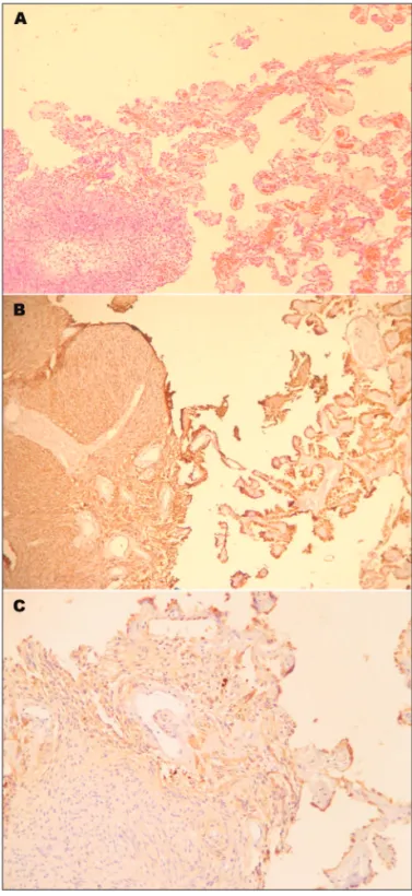Fig 2. Histological features of the resected specimen. [A] Typical  schwannoma surrounded by choroid plexus