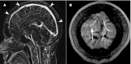 Fig 3. Axial FLAIR (9000/2500/80) image, 10 days after the irst ex- ex-amination, showing complete resolution of the indings.