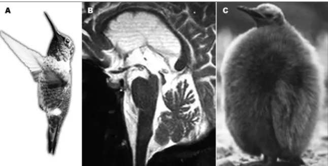Fig 1. Brain T2-weighted sagital MR scan from a PSP patient [B]. Notice the relative atrophy of the mesencephalon as  compared with the pons