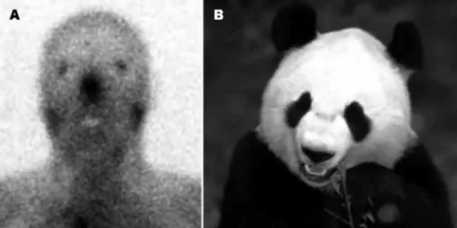 Fig 3. Galium-67 scintigraphy. Panda’s sign due  to simectirc galium uptake in the parotid and  lachrymal glands [A]