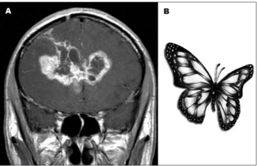 Fig 4. T1-weighted contrast enhanced coronal  MR imaging showing an irregular lesion  hypoin-tense at the centre with hyperinhypoin-tense margins  invading the frontal lobes [A]