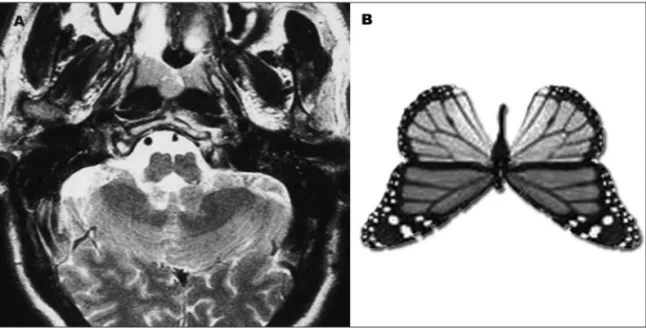 Fig 5. T2-weigthed brain MRI, axial view. Dysplasic and athrophic medulla with a particularly pronounced ventral sulcus  [A]