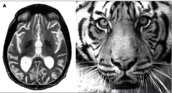 Fig 7. T2-weigthed axial brain RMI showing hyperintense signal (necrosis) surrounded by hyperintense (iron  accumulation) at the medial aspects of the globus pallidus [A]