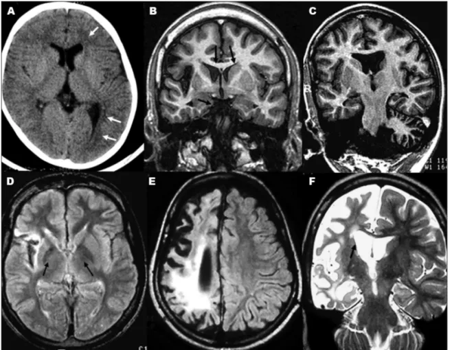 Table summarizes clinical, EEG and image indings. The  age at onset ranged from 2 to 10 years (mean 6.4 years)