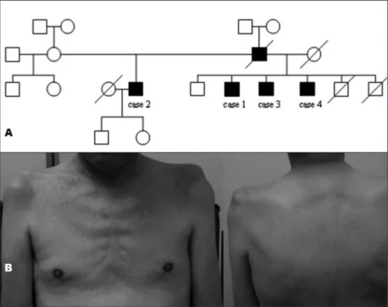 Fig 1. [A] Pedigree analysis shows male-to-male gene transmission suggesting autosomal dominant in- in-heritance