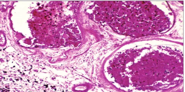 Fig 3. Histology of a typical cavernous malformation with endothelium-lined, sinusoidal cavities without oth- oth-er features of normalblood vessels, such as muscular or adventitial layoth-er