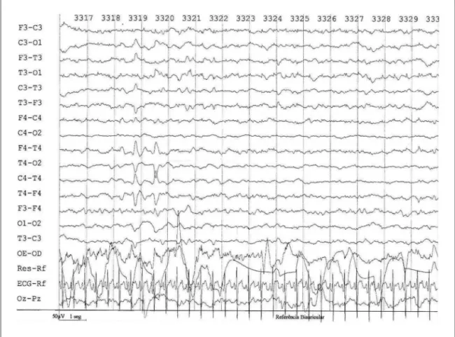Fig 1. Newborn to 39 4 / 7 weeks gestational age and 40 weeks of conceptional age. Presented a EEGN with a BA with  immature pattern corrected for age and PSW temporal