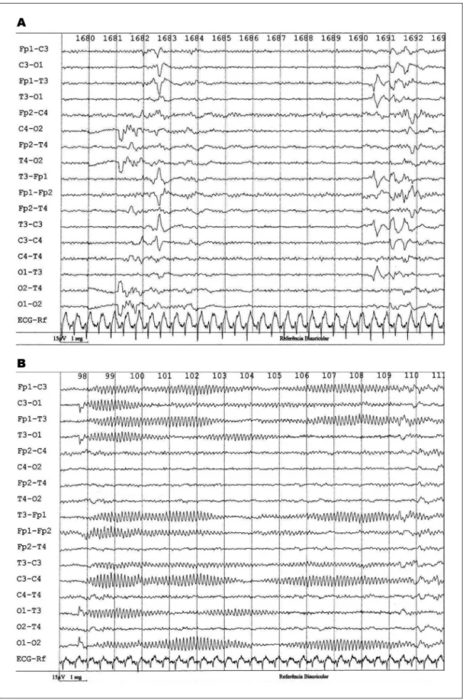 Fig 3. Preterm to 32 1 / 7 weeks gestational age and 33 weeks of conceptional age. Presented a EEGN with burst –sup- –sup-pression pattern, PSW left central, left temporal, left frontal and electrographic seizures