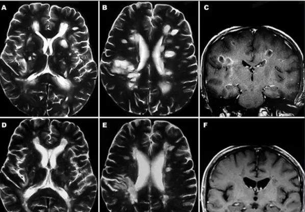 Fig 4. Case 2. A 49-year-old male patient with ADEM/MDEM. Axial T2-weighted [A and B] and coronal T1- T1-weighted after gadolinium administration [C] show multiple hyperintense oval and round lesions bilaterally in  the white matter, mainly in the peri-ven
