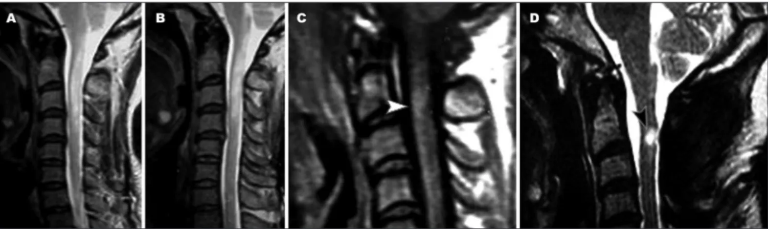 Fig 6. Case 4.A 43-year-old female patient with ADEM. Sagittal T2-weighted [A and B] and T1-weighted after gadolinium administration [C] MR  images show a hyperintense lesion extending from the medulla oblongata to the level of C4, which demonstrate an are