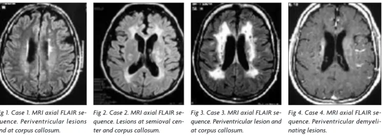 Fig 2. Case 2. MRI axial FlAIR se- se-quence. lesions at semioval  cen-ter and corpus callosum.