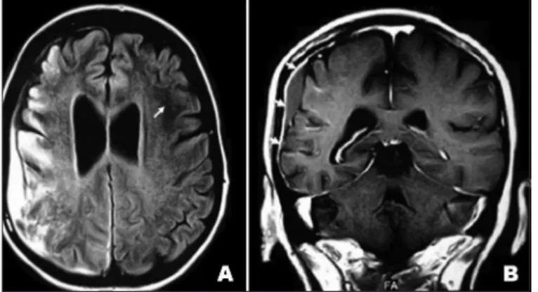 Fig 2. [A] FLAIR axial MRI discloses a right parietal hyperintense sub- sub-dural collection