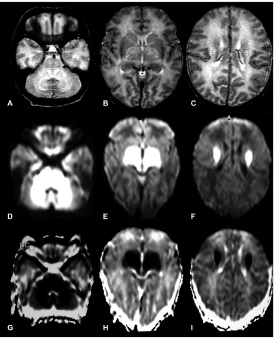 Fig 1. Axial - T2-weighted [A–C], diffusion-weighted [D–F], ADC maps [G–I]: in the acute metabolic  decompensation shows hyperintense lesions on the diffusion-weighted images and hypointense on  ADC maps in the brainstem, basal ganglia, thalami and white m