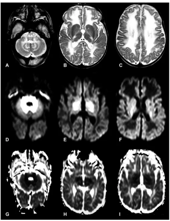 Fig 2. Follow-up after twenty days show new hyperintense lesions on the T2-weighted images and  hyperintense on ADC maps in the unmyelinated white matter of the frontal, parietal and temporal  lobes, which demonstrate a vasogenic pattern of edema.