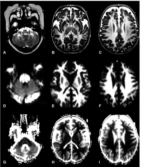 Fig 3. After eight months, there are persistence of hyperintense lesions on the T2-weighted images in  the white matter frontal, temporal and parietal lobes with hyperintense in diffusion-weighted  imag-es and hypointensimag-es on ADC maps, which demonstra