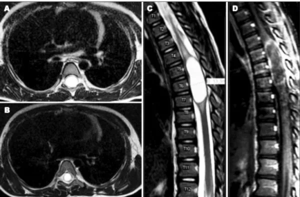 Fig 1. MRI showing high signal lesion on T2, extending from T5–T7 [A, B and C]. T1 after gadolinium shows het- het-erogeneous enhancement [D].