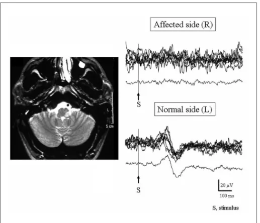 Fig 5. (A) Normal thermal thresholds in the  quantitative sensory testing for temperature; 