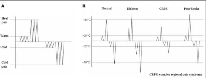 Fig 6. Small amplitude contact-evoked heat potentials applied in the symptomatic side of a patient with meralgia paresthet- paresthet-ica (Schestatsky et al